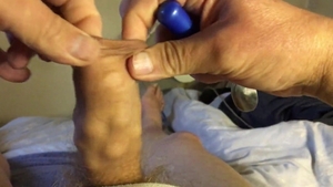 Foreskin Filled With 23 Marbles Plus Plastic Ball